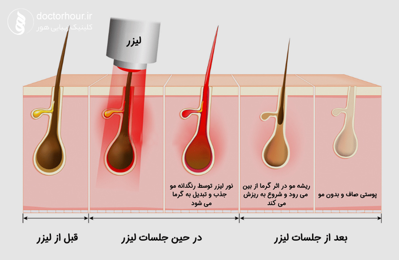 لیزر موهای زائد چیست